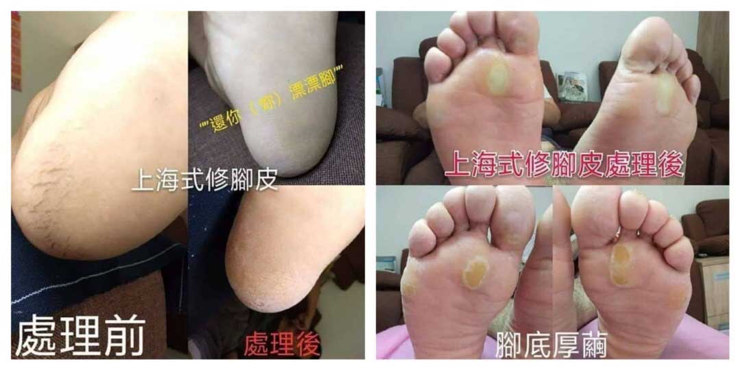 , 腳皮亀裂厚繭與灰指甲凍甲好困擾？